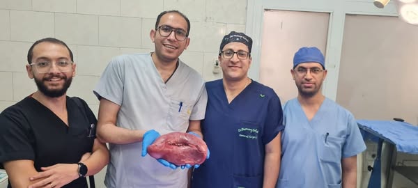نجاح جراحة معقدة لاستئصال طحال متضخم وزنه 2 كجم في مستشفى أسيوط العام