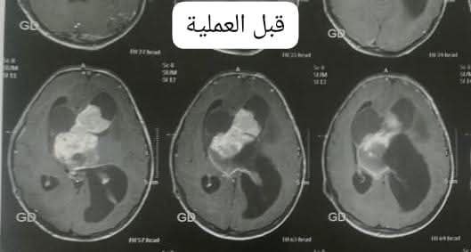 فريق طبي بقسم جراحة المخ والأعصاب بمستشفيات جامعة أسيوط ينجح في استئصال ورم ضخم من مخ طفلة بعد عملية جراحية معقدة