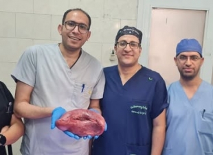 نجاح جراحة معقدة لاستئصال طحال متضخم وزنه 2 كجم في مستشفى أسيوط العام